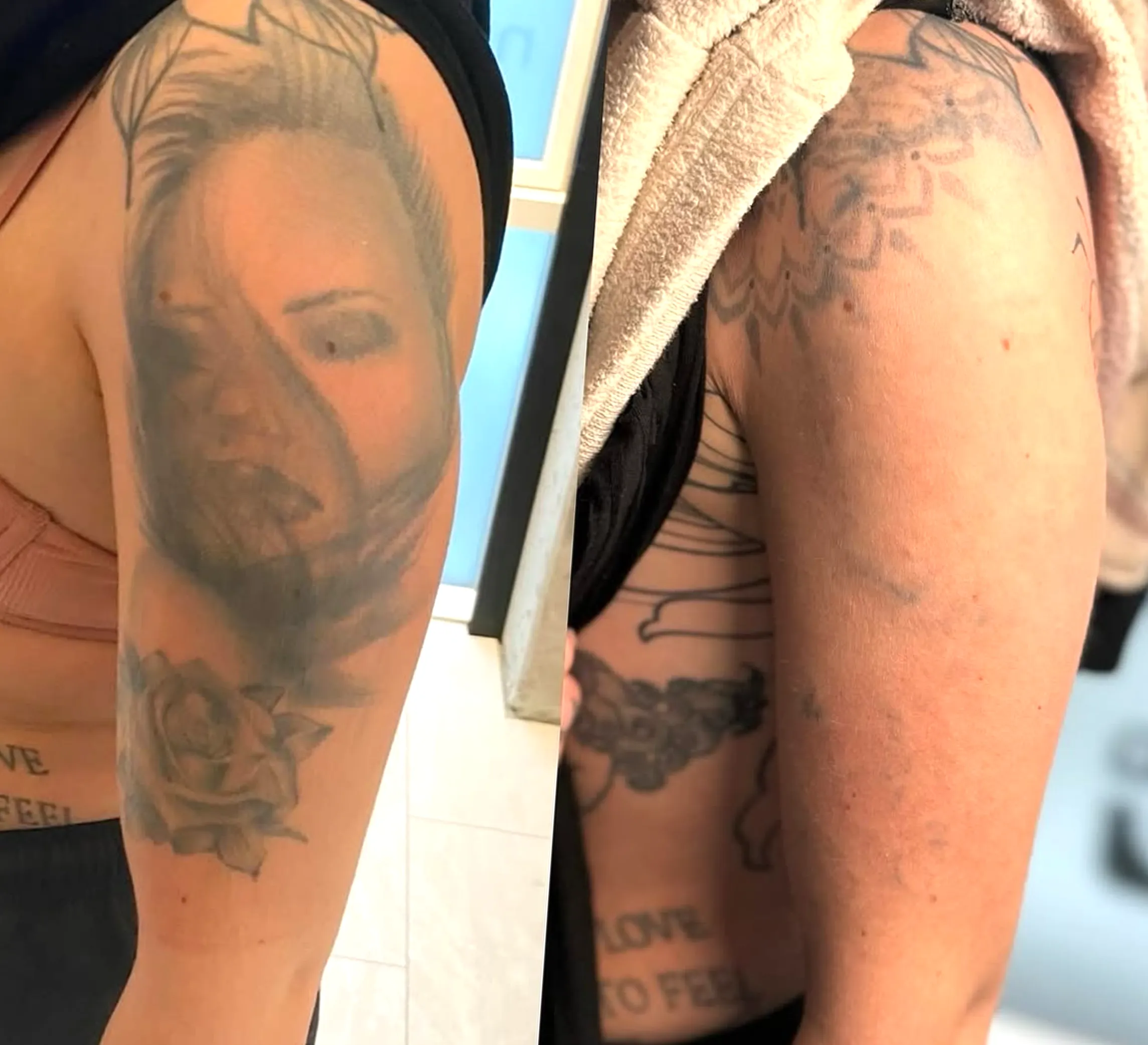 laser eyeliner tattoo removal
