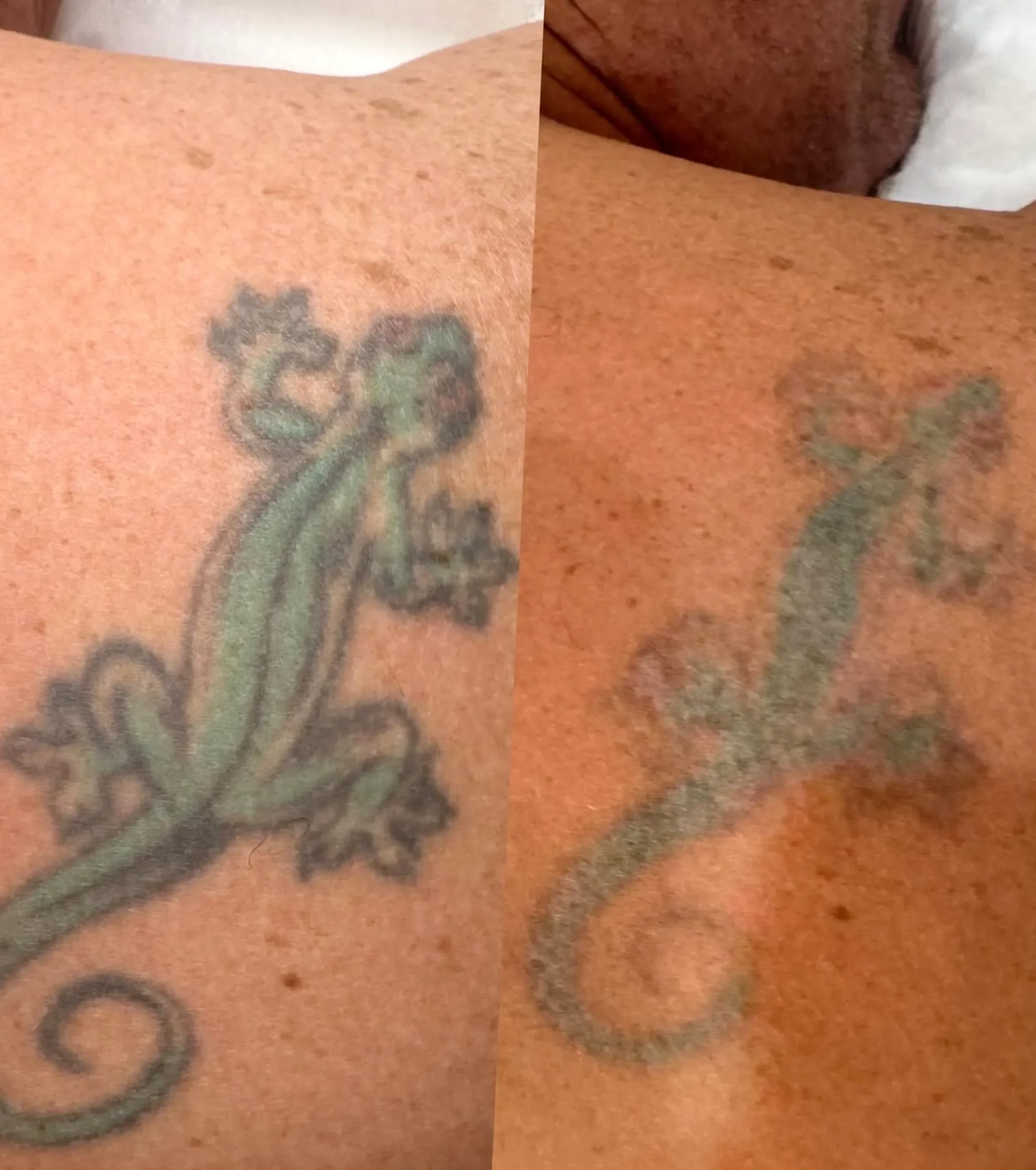 colour tattoo removal