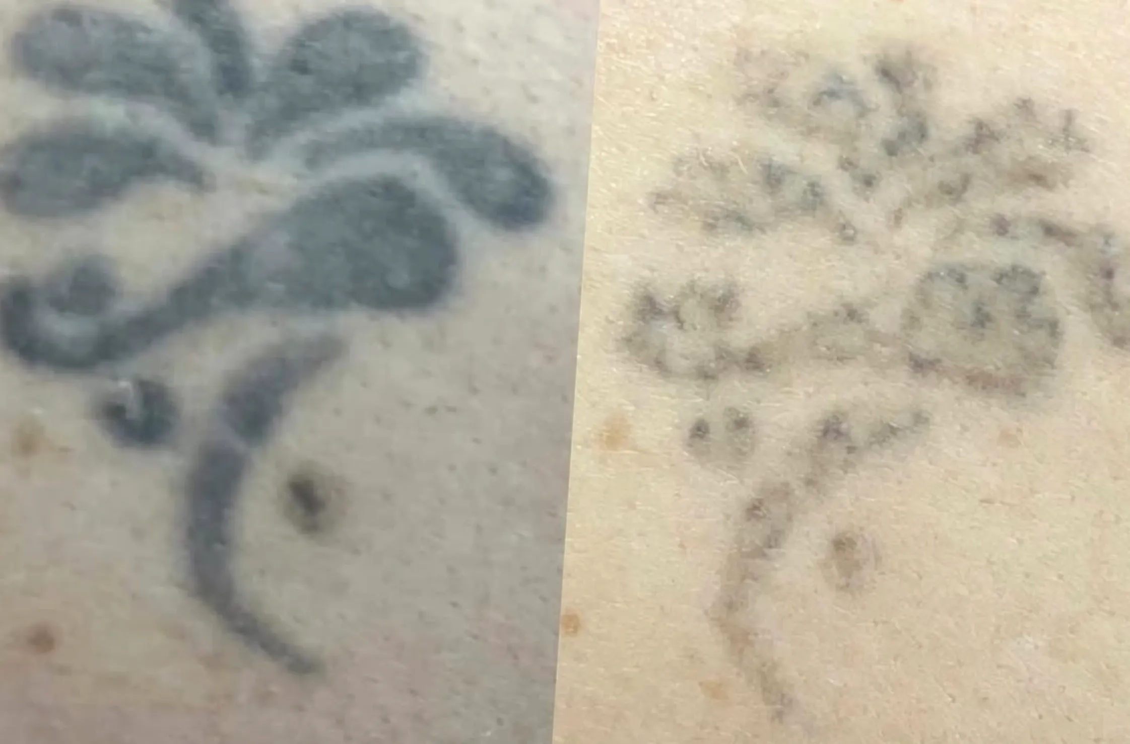 black ink tattoo removal