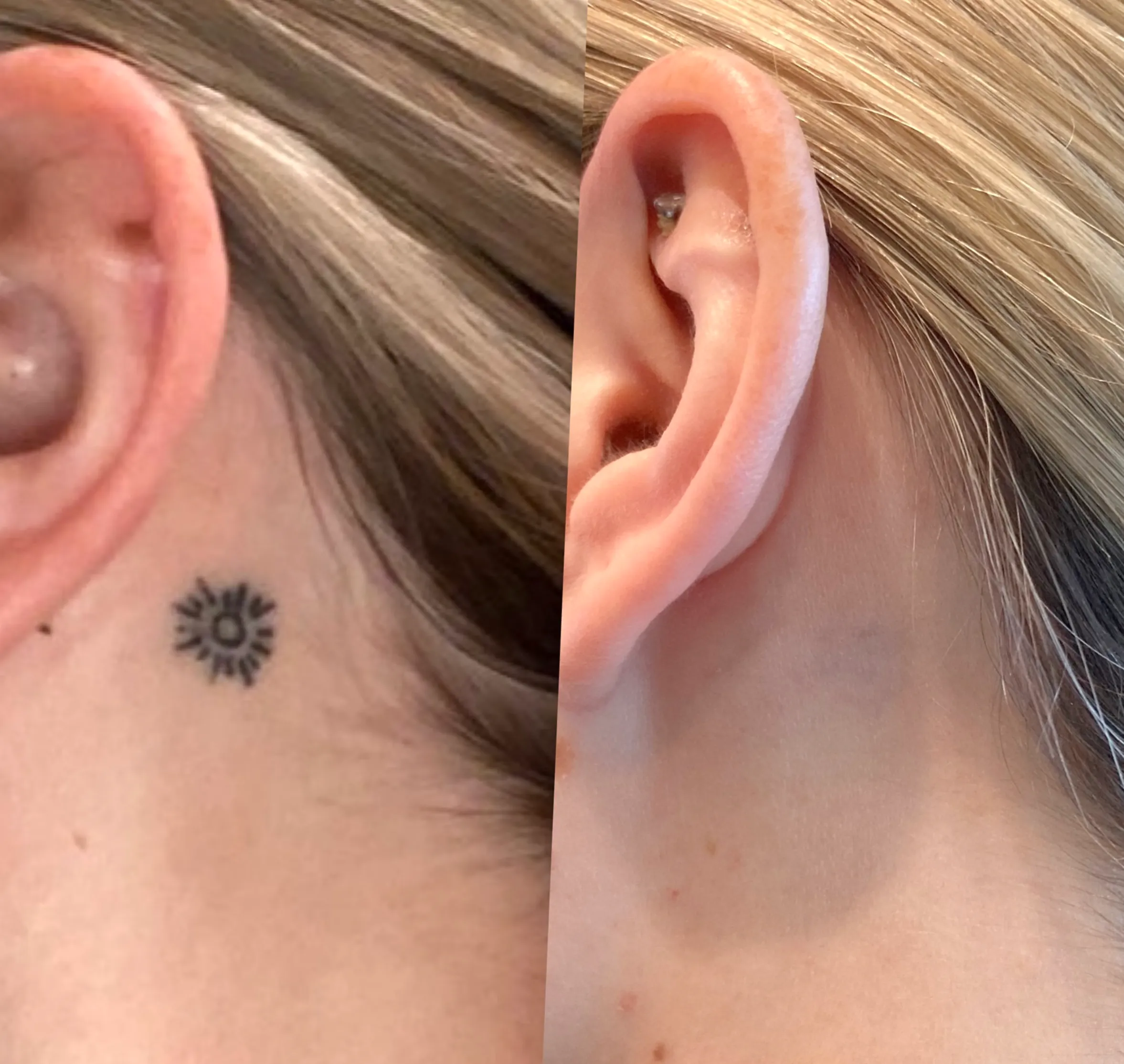 laser tattoo removal Melbourne