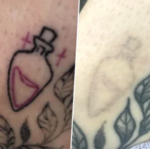 are older tattoos easier to remove