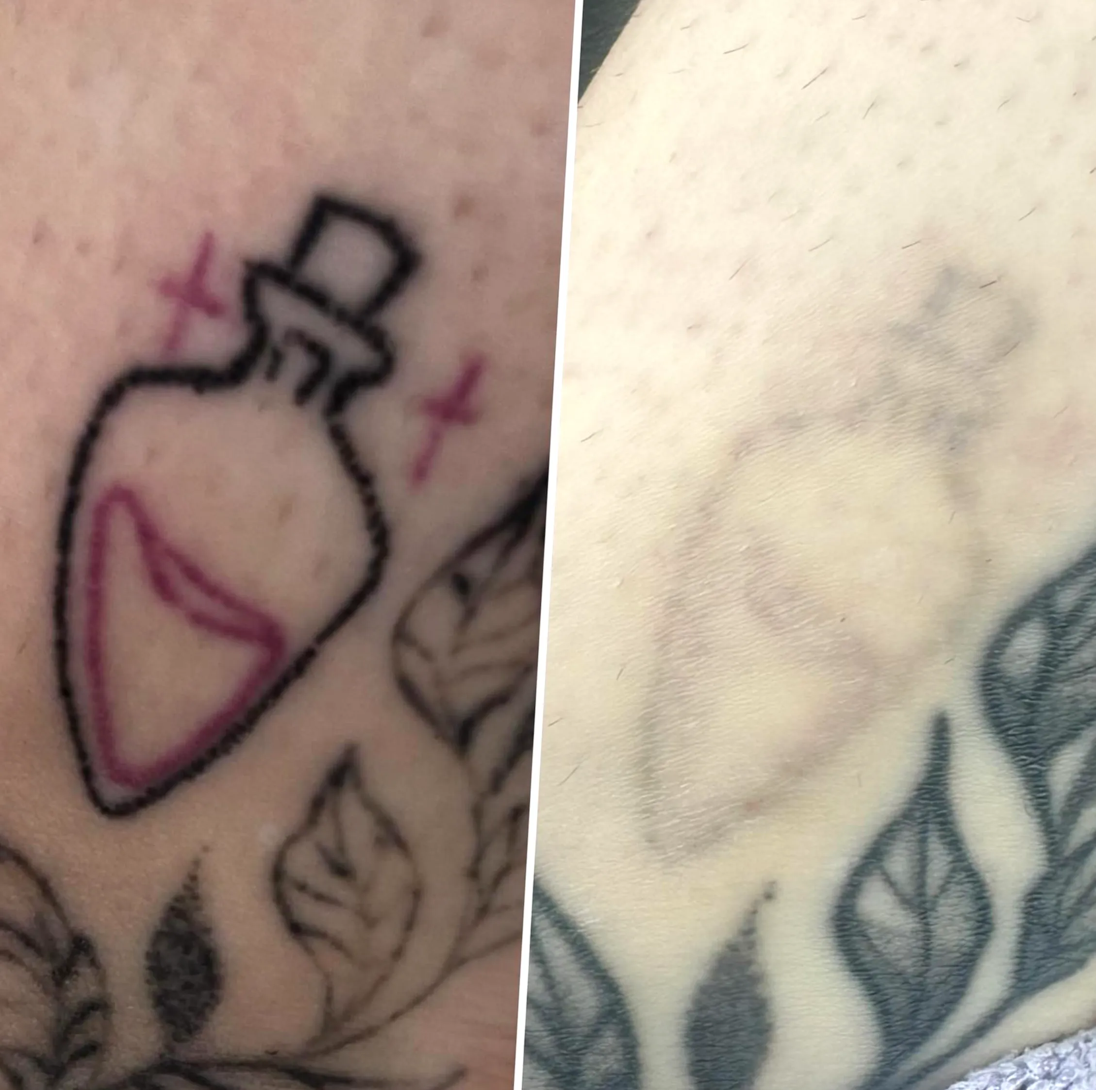 Are older tattoos easier to remove?